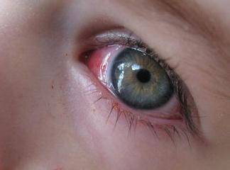 Adenovirüs Göz Tedavisi