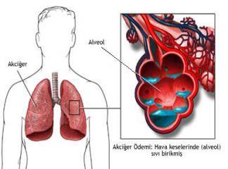 Akciğer Ödemi Hakkında Bilgi