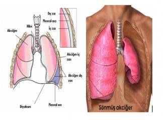 Akciğer Ödemi Hastalığı Nedeni 