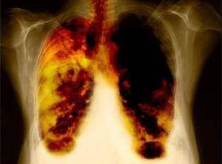 Akciğer ödeminin tanı ve tedavisi