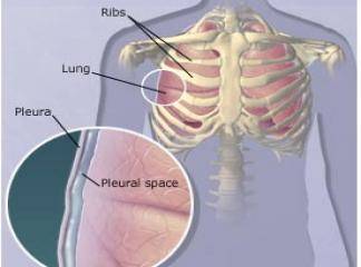 Akciğer Sertleşmesi Nedir?