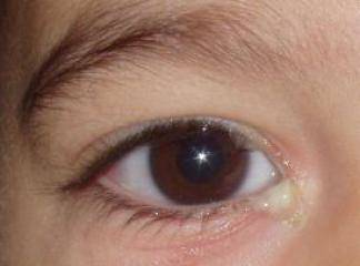 Bebeklerde Göz Kanalı Tıkanıklığı Ameliyatı