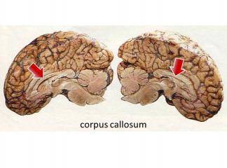 Corpus Callosum Bulgular