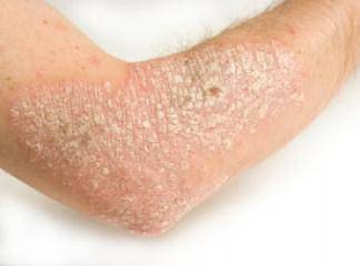 Dermatit Egzama