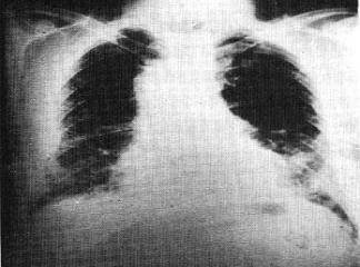 Diffüz İnterstisiyel Restriktif İnfiltratif Akciğer Hastalıkları
