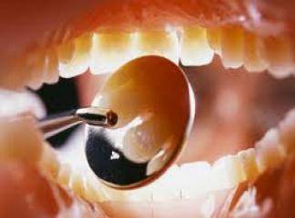Diş Çürükleri Tedavisi