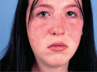 Diskoid Lupus Eritematozus