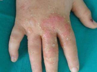 Kontak Dermatit