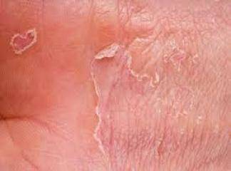 Kontakt Dermatit Tedavisi