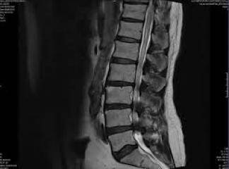 Lomber Spinal Stenoz