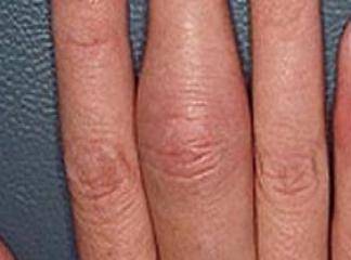 parmaklarda şişlik neden olur
