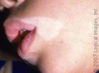 Vitiligo Hastalığı Belirtileri