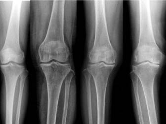 Osteofit Tedavisi