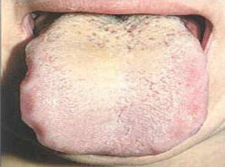 Dil Kökündeki Mantar Enfeksiyonları