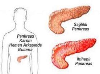 Pankreas İltihabı