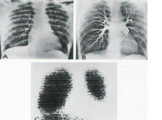 akciğer embolisi ölüm riski varmıdır