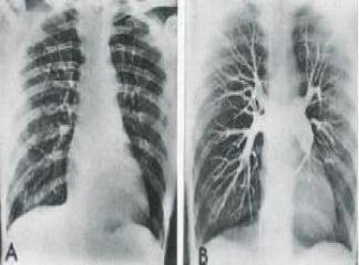 akciğer embolisinin nedenleri