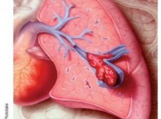 Akciğer embolisi (pulmoner emboli)
