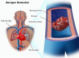 Akciğer Embolisi Ve Akciğer Anfizemi Hastalığı Nedir ?