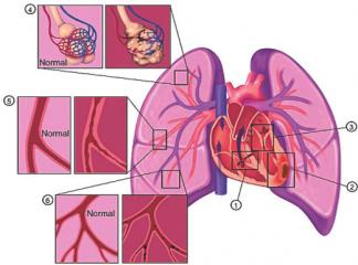 Akciğer Hipertansiyonu Belirti