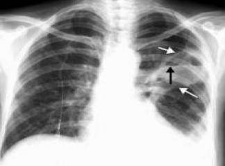 akciğer hastalıkları nelerdir nasıl tedavi edilir