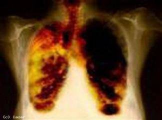 Akciğer Su Toplaması Kanser