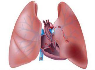 Derin Ven Trombozu ve Akciğer Embolisi