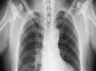 Gırtlak ve Akciğer Kanseri