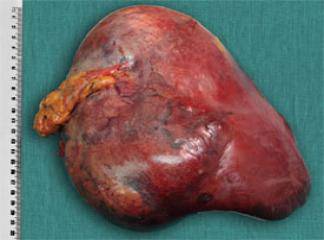 Karaciğer Kanseri Belirtileri Nelerdir