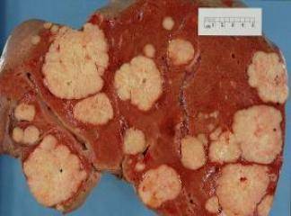 karaciğerde tümör nedir