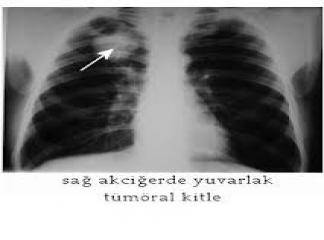 Küçük Hücreli Akciğer Kanseri Tedavisi