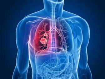 Akciğer Kanseri Nasıl Ortaya Çıkar Belirtileri Nelerdir